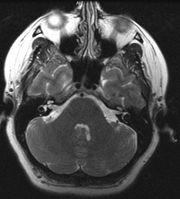 prawidłowy obraz mózgu w MRI